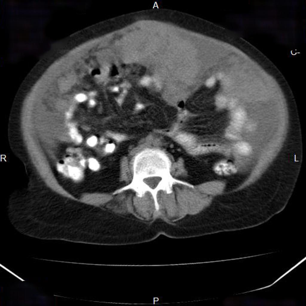 Cancer de l'ovaire avec carcinose péritonéale