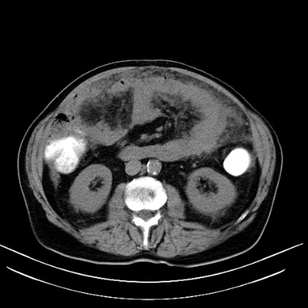 Carcinose péritonéale : nodules péritonéaux