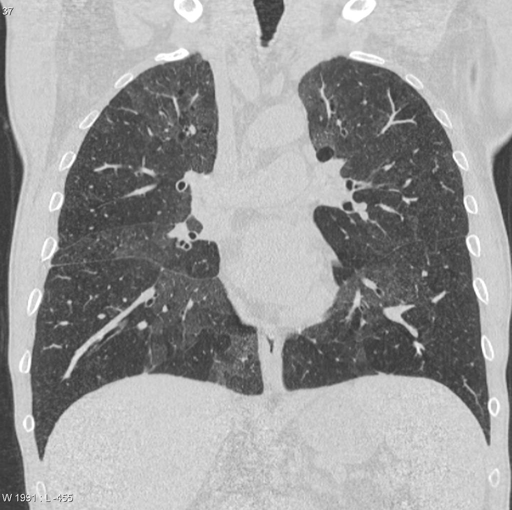 Case courtesy of A.Prof Frank Gaillard, Radiopaedia.org. From the case rID: 6535