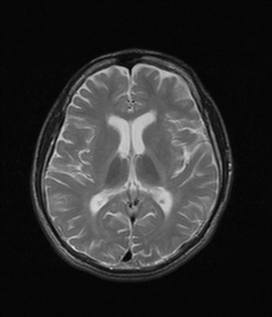 toluene-related-leukoencephalopathy-1 – PinkyBone