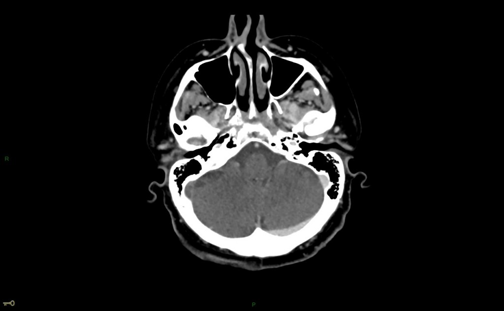 Thrombose veineuse cérébrale du sinus latéral droit