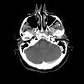 Thrombose veineuse cérébrale du sinus latéral droit