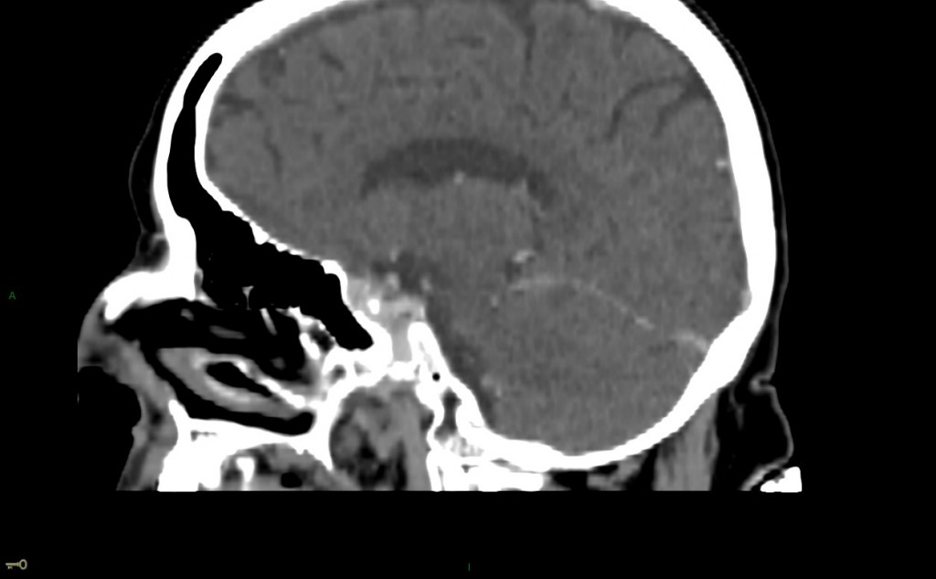 Thrombose veineuse cérébrale du sinus latéral droit