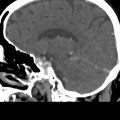 Thrombose veineuse cérébrale du sinus latéral droit