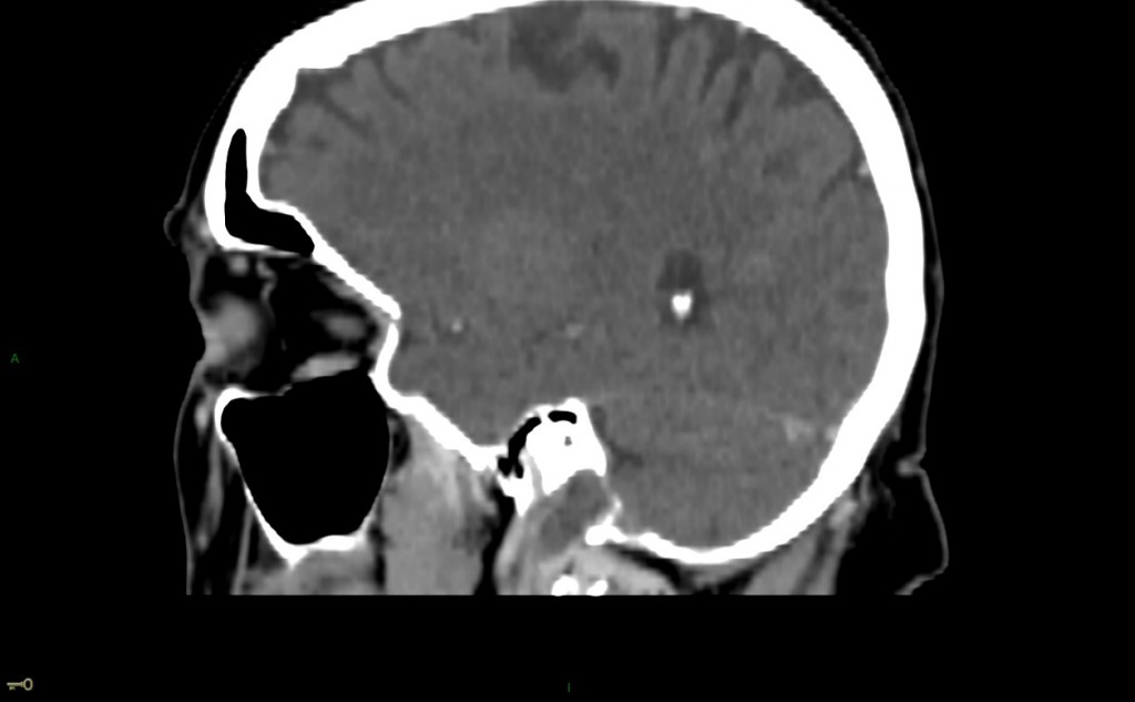 Thrombose veineuse cérébrale du sinus latéral droit