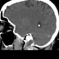 Thrombose veineuse cérébrale du sinus latéral droit
