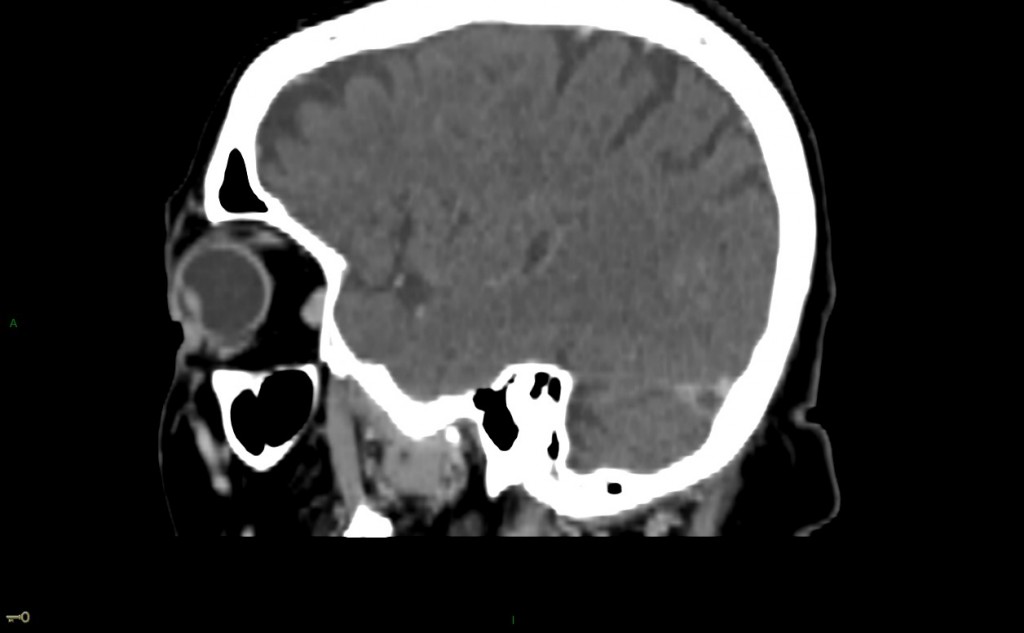 Thrombose veineuse cérébrale du sinus latéral droit