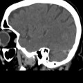 Thrombose veineuse cérébrale du sinus latéral droit