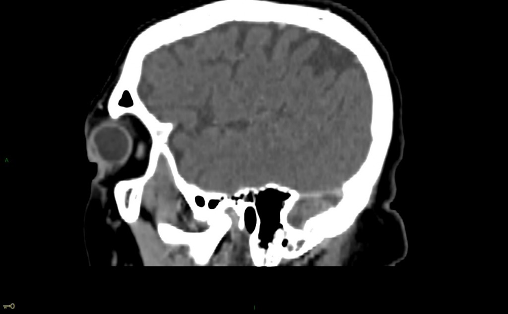 Thrombose veineuse cérébrale du sinus latéral droit