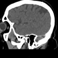 Thrombose veineuse cérébrale du sinus latéral droit