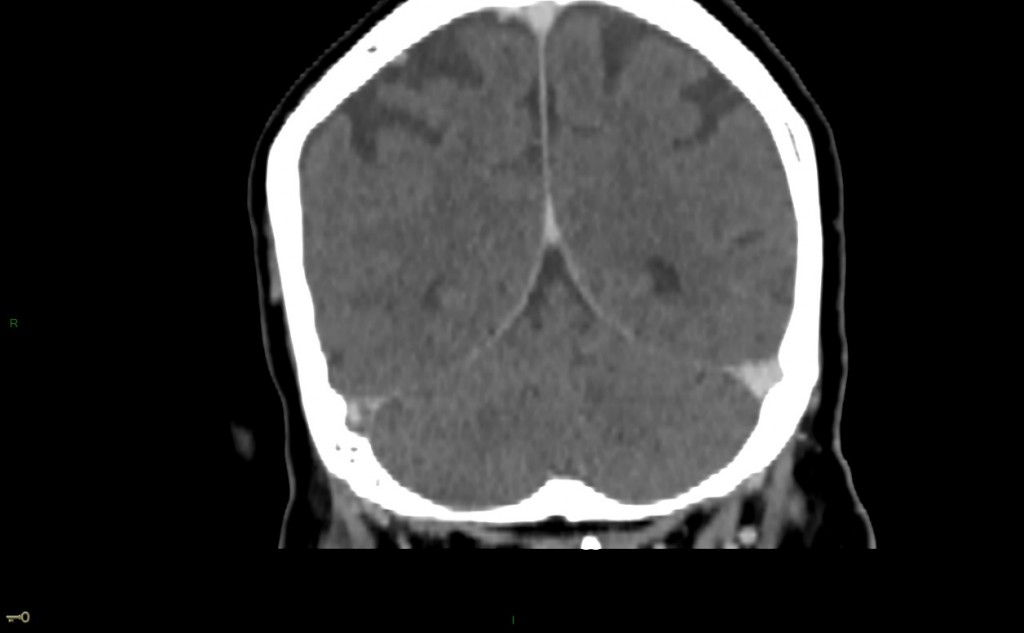 Thrombose veineuse cérébrale du sinus latéral droit