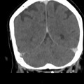 Thrombose veineuse cérébrale du sinus latéral droit