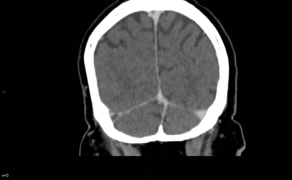 Thrombose veineuse cérébrale du sinus latéral droit