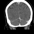 Thrombose veineuse cérébrale du sinus latéral droit