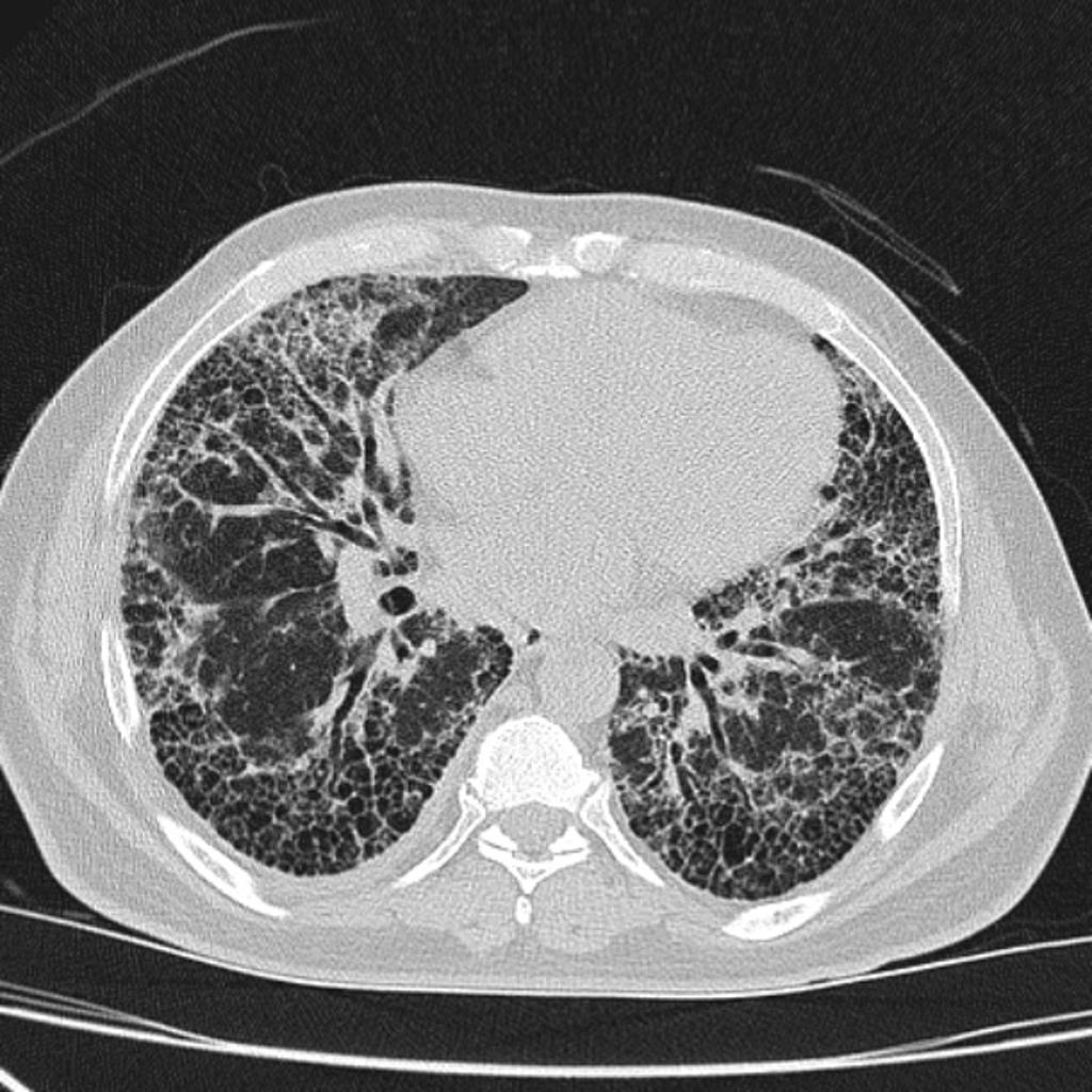 Case courtesy of Dr David Cuete, Radiopaedia.org. From the case rID: 27858