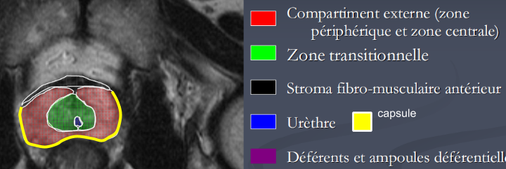 ABD - Prostate IRM 10-09-2014.pptx (1)