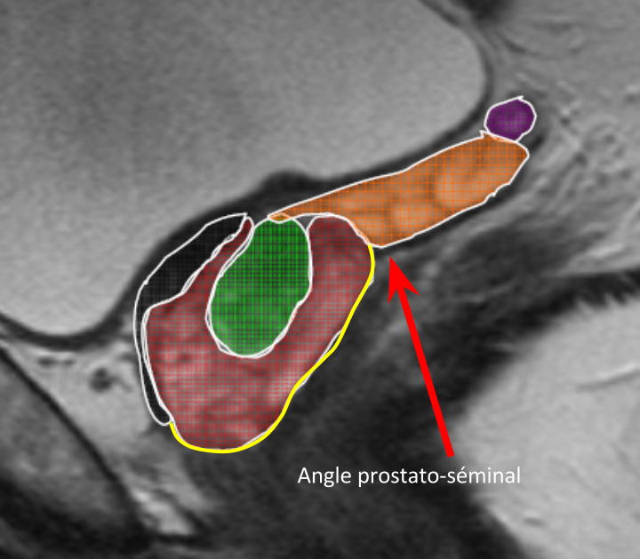 ABD - Prostate IRM 10-09-2014.pptx (2)