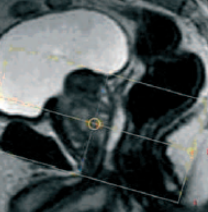 ABD - Prostate IRM 10-09-2014.pptx