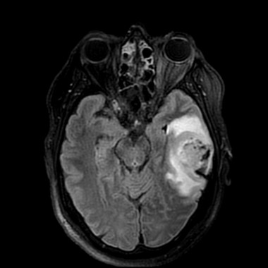 glioblastome pinkybone tumeurs gbm neuro ax