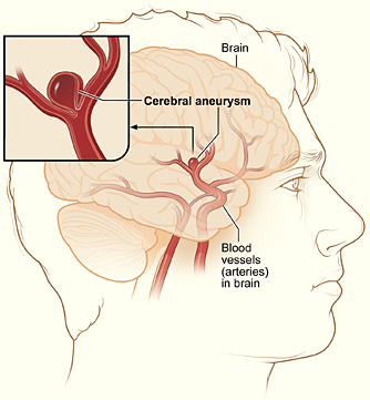 Cerebral_aneurysm_NIH