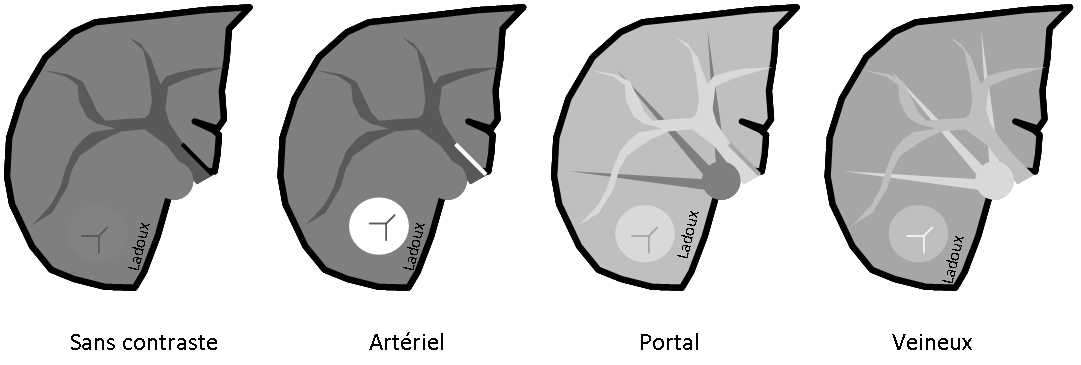 Hyperplasie nodulaire focale