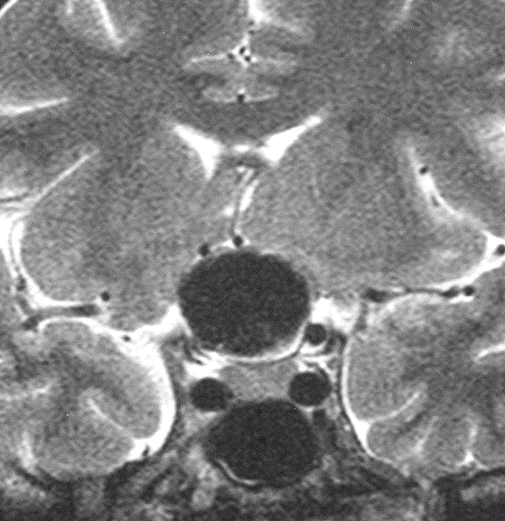 Anévrisme intracrânien