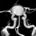 Anévrisme intracranien