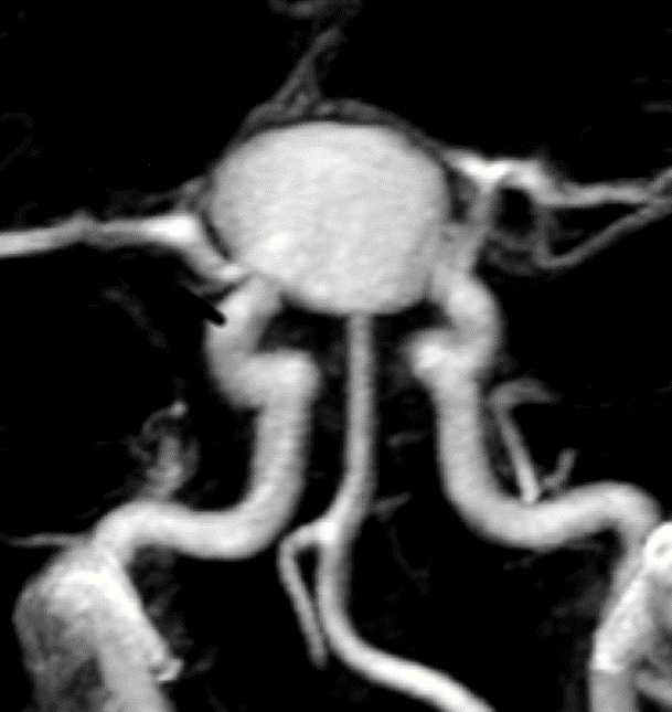 Anévrisme intracranien