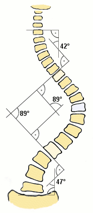 Scoliose Cobb