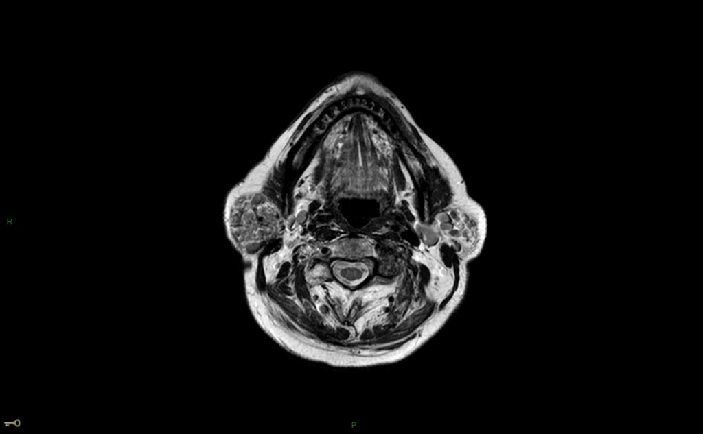 Syndrome de Gougerot-Sjögren (syndrome sec)