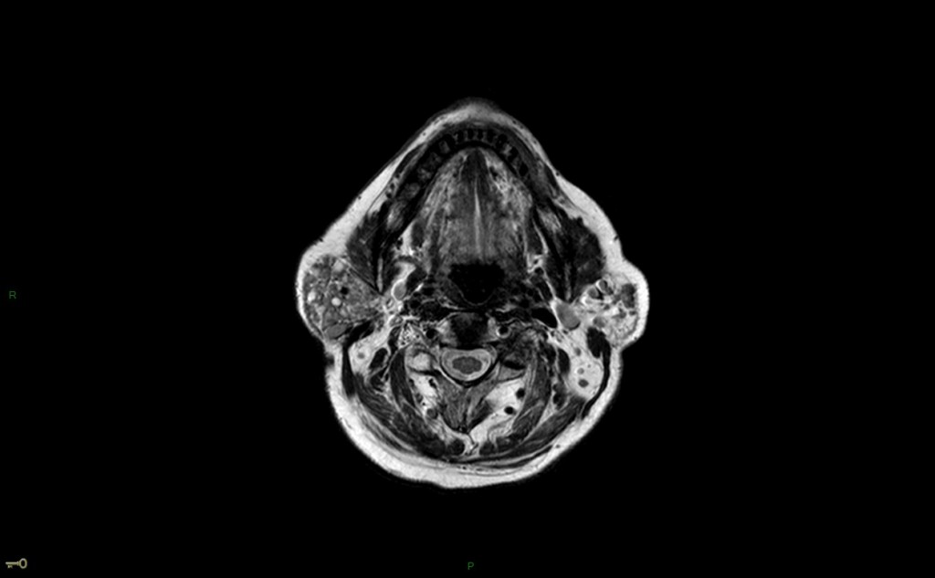 Syndrome de Gougerot-Sjögren (syndrome sec)