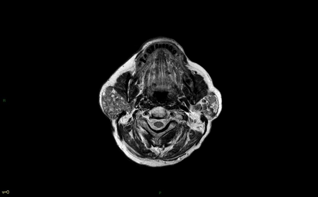 Syndrome de Gougerot-Sjögren (syndrome sec)