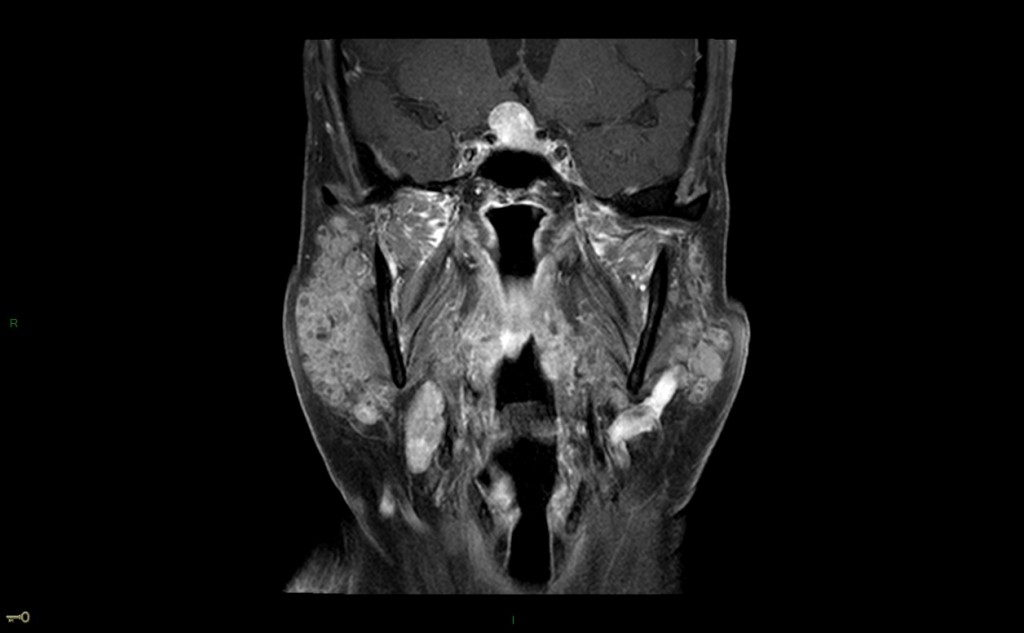 Syndrome de Gougerot-Sjögren (syndrome sec)