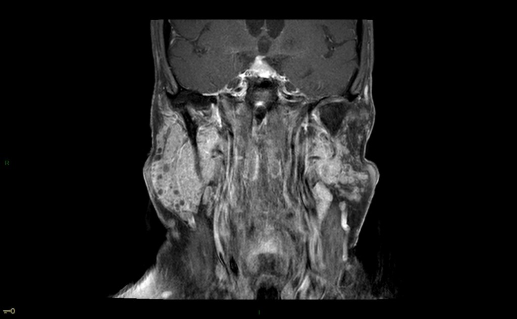 Syndrome de Gougerot-Sjögren (syndrome sec)