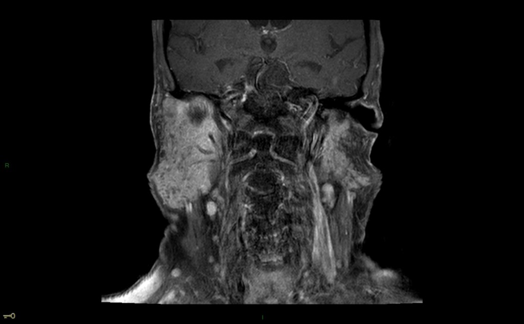 Syndrome de Gougerot-Sjögren (syndrome sec)