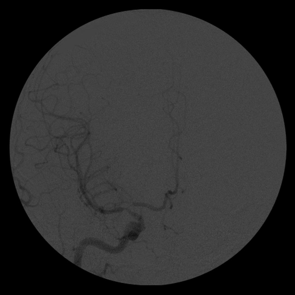 Syndrome de vasoconstriction réversible