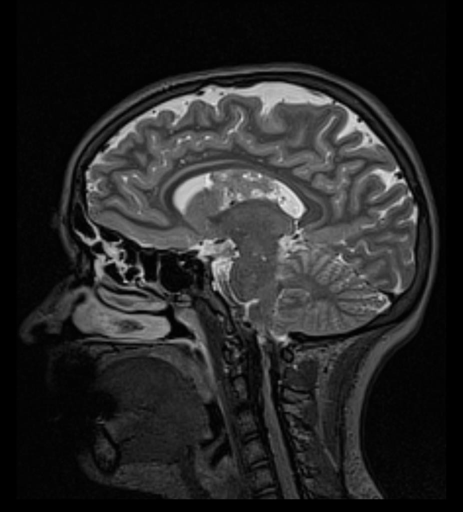 Neurocytome central