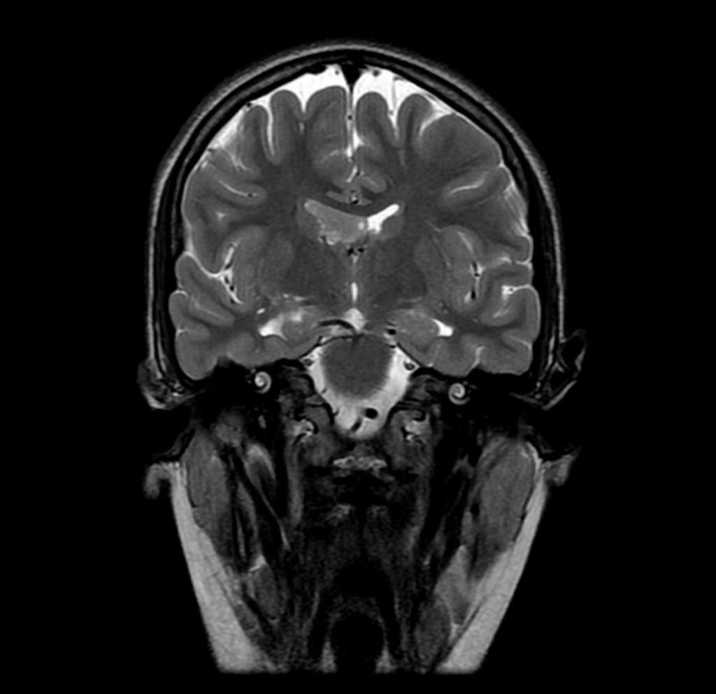 Neurocytome central