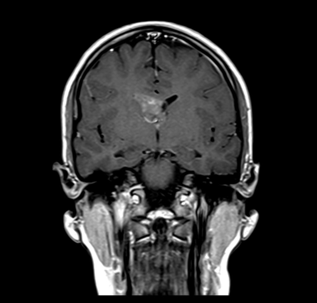 Neurocytome central