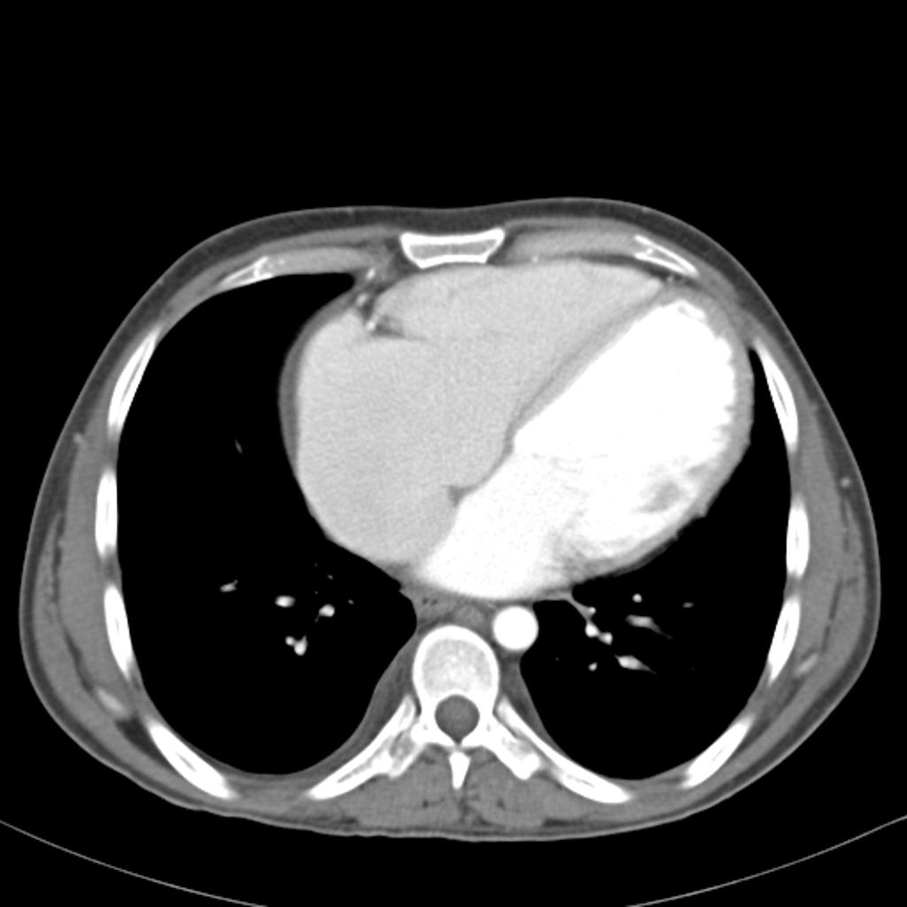 Cardiomyopathie dilatée (CMD)