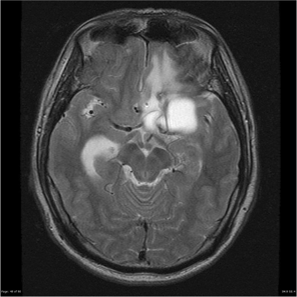 Épendymome du ventricule latéral