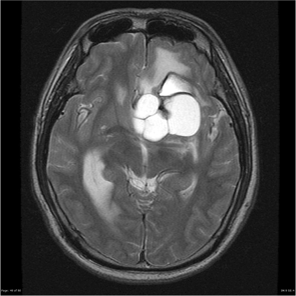 Épendymome du ventricule latéral