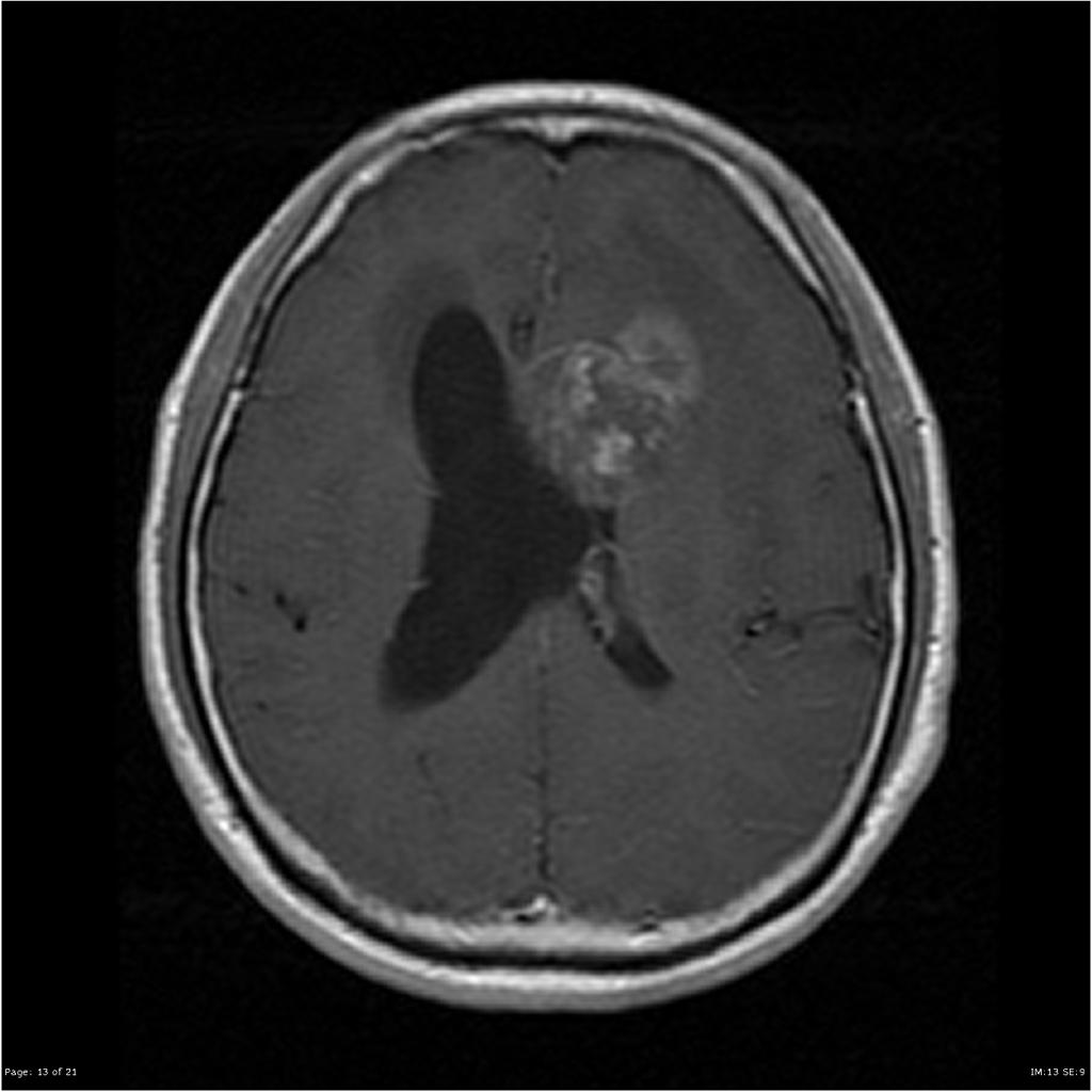 Épendymome du ventricule latéral