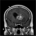 Épendymome du ventricule latéral