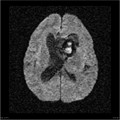 Épendymome du ventricule latéral