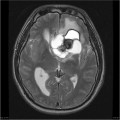 Épendymome du ventricule latéral