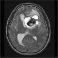 Épendymome du ventricule latéral