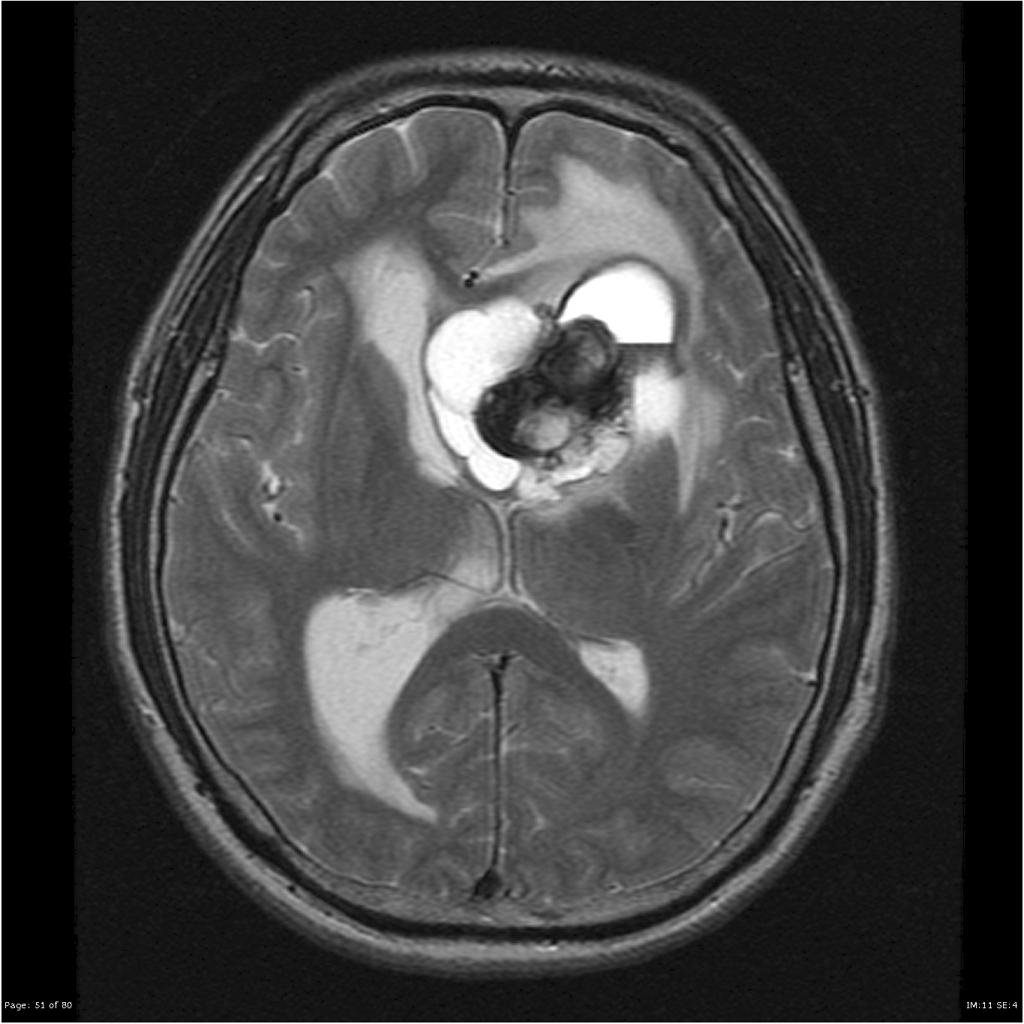 Épendymome du ventricule latéral