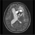 Épendymome du ventricule latéral