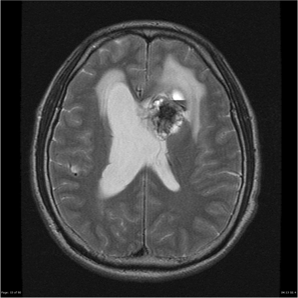 Épendymome du ventricule latéral